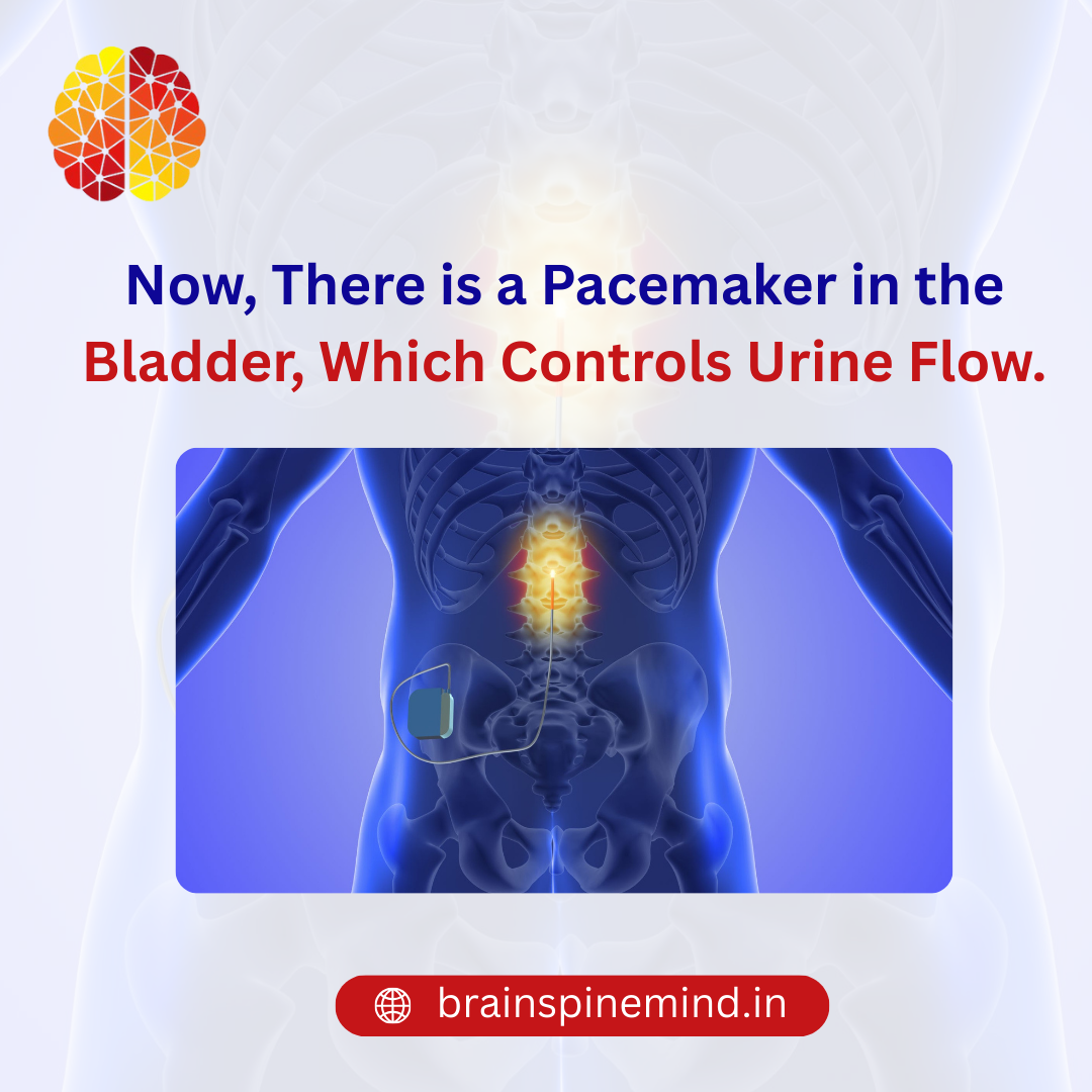  Now There is a Pacemaker in the Bladder, Which Controls Urine Flow.